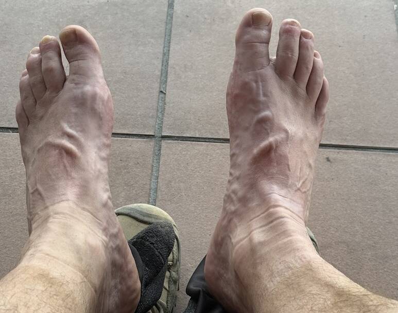 David Box's feet after breaking in walking boots on the Camino. Picture by David Box